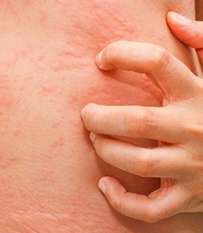 Eczema Treatments