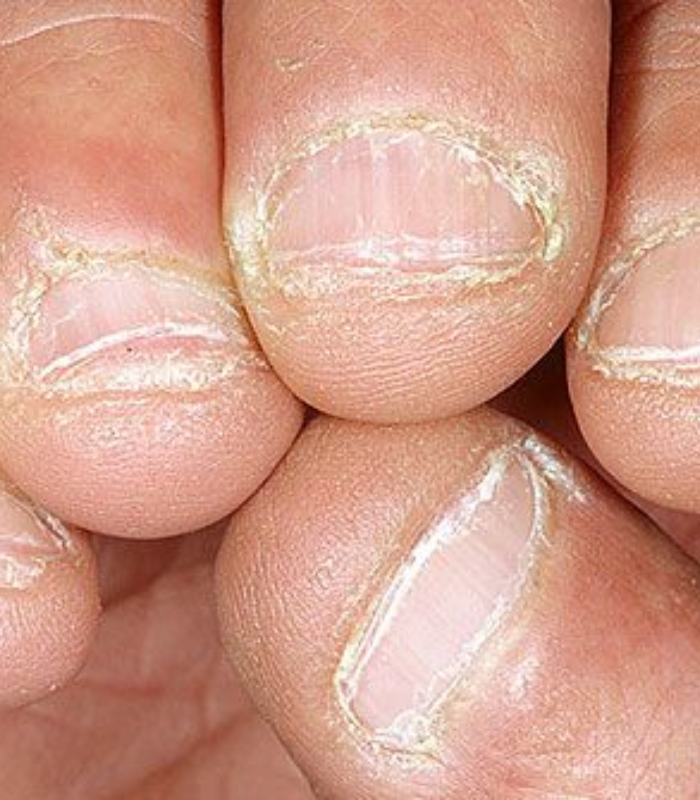 Nail Problems