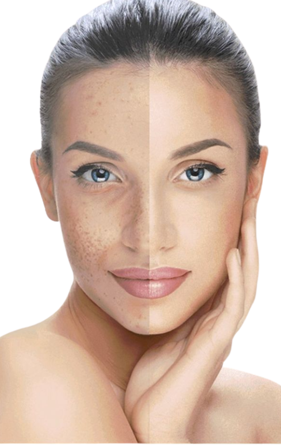 Melasma