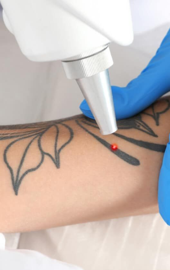 tattoo removal