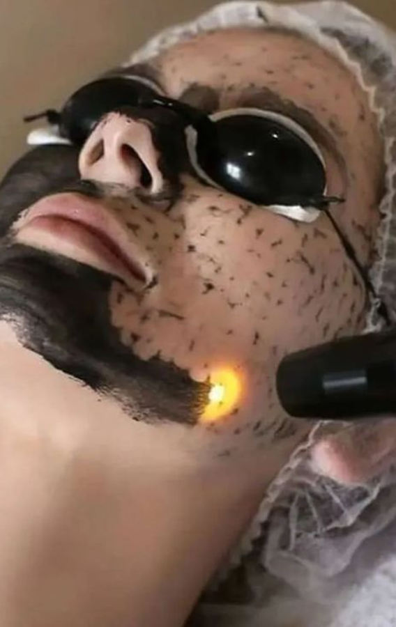 chemical peel