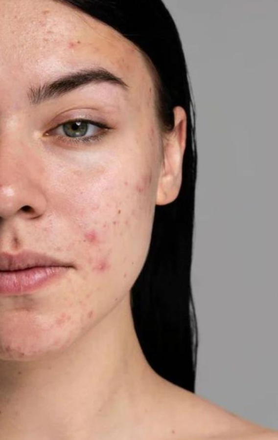 acne scar