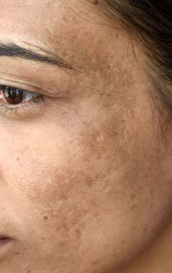 pigmentation