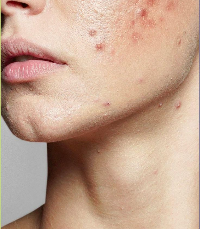 Acne Treatment