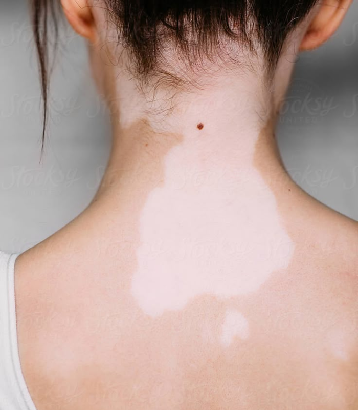 Vitiligo Treatment