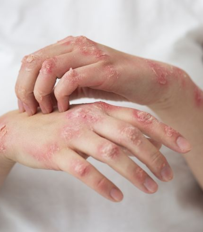 Psoriasis